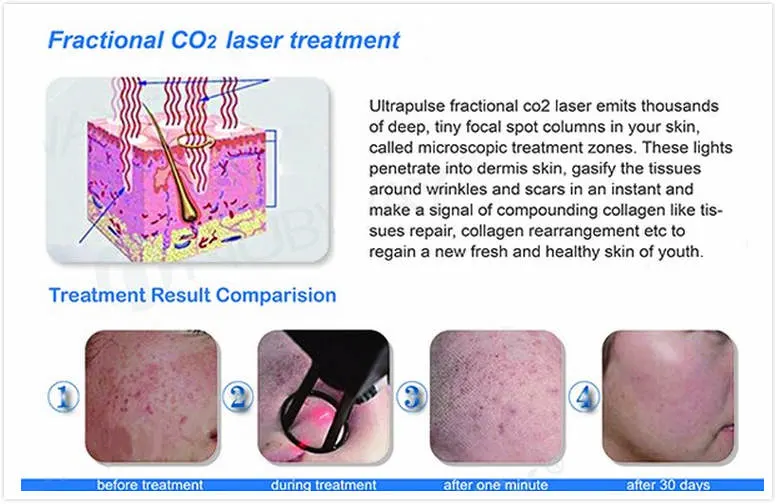 2023 Promotion Surgical Laser Scars Removal Vaginal Tightening&Rejuvenation RF Fractional CO2 Laser for CO2 Acne Scar Treatment