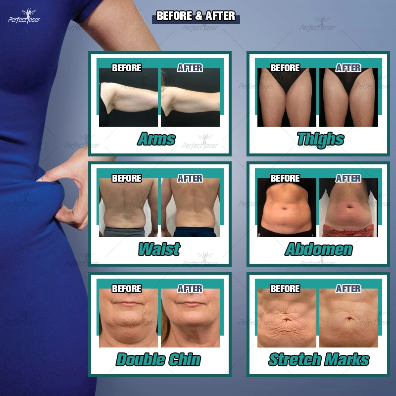 Salón Cryoliposis Slimming Kim 8 Especial con Lipolaser 360 Belleza Equipo