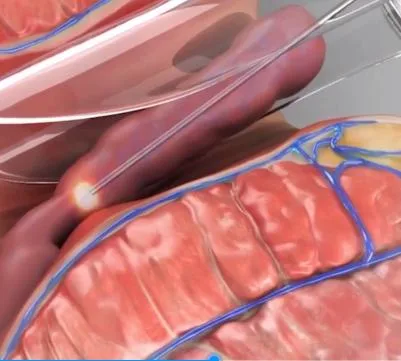 A mais recente fenda de fístula anal Hemorrhoids de 980 nm do laser de díodo 1470 nm Tratamento de Pilonidalis sinusal Proctologia instrumento Laser cirúrgico