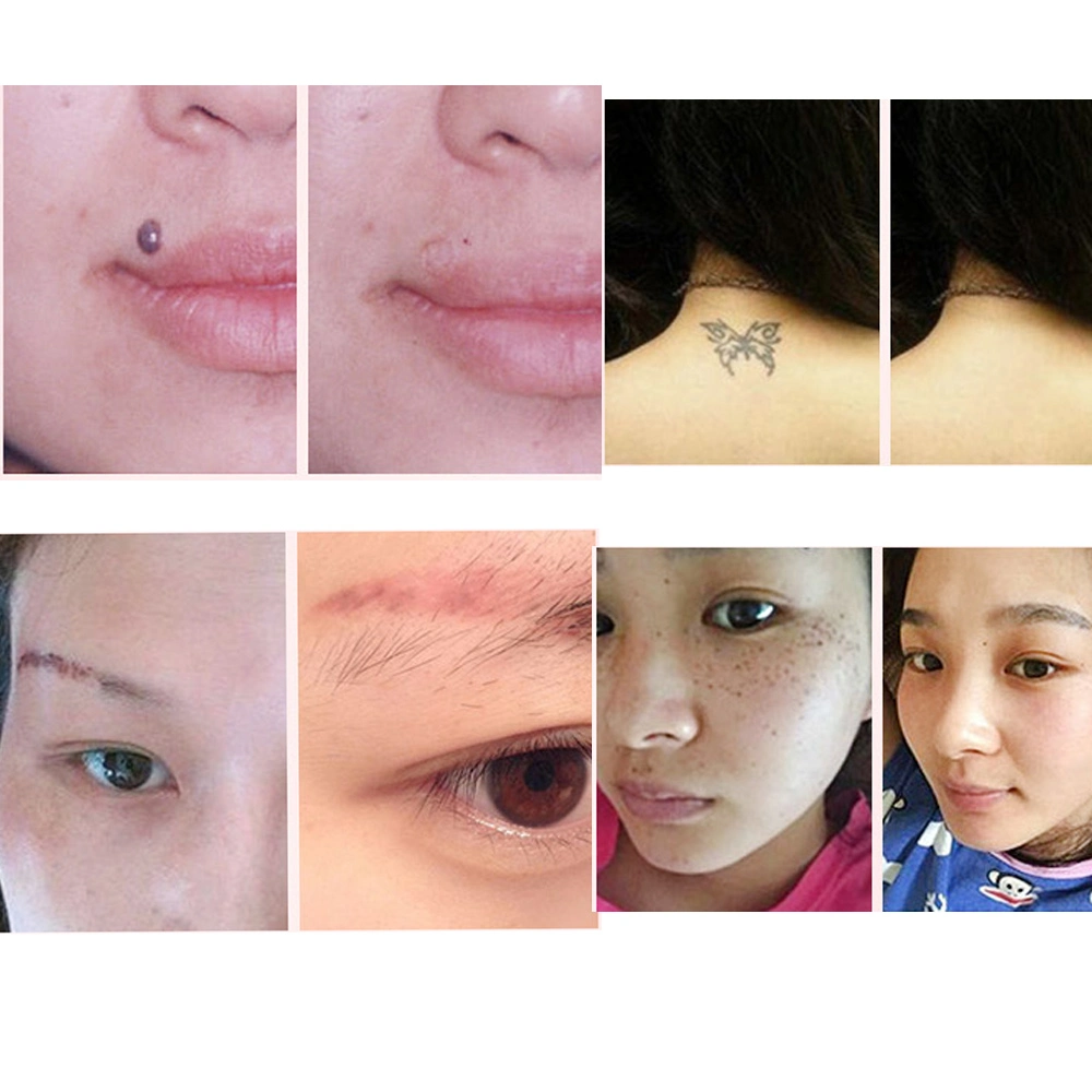 New Product Laser Picosecond Pen for Acne Mark Removal