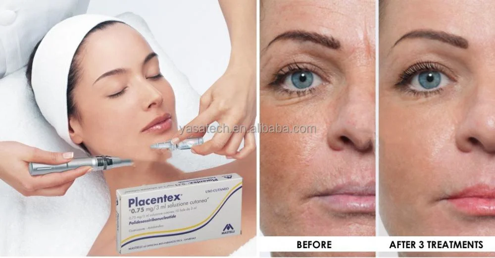 Estructura de la piel Placitex rejuvenecimiento de la piel 5,625mg/3ml Facial de relleno Dermal inyectable Reparar