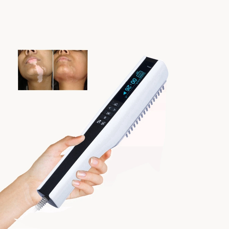 UVB Phototherapy Lamp Skin Treatment for Vitiligo Psoriasis Eczema Dermatitis