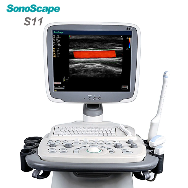 Sonoscape Hot-Sale Color Doppler 4D Trolley Cart Ultrasound Machine
