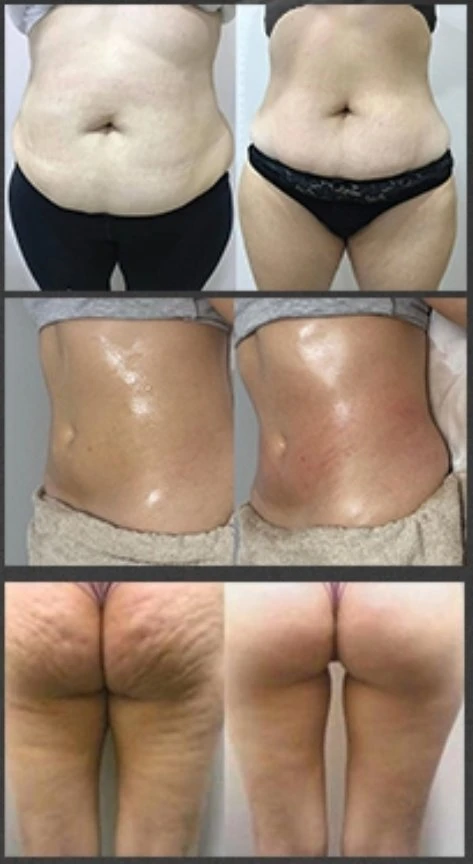 Vela V9 Body Contouring Extracción de celulitis rodillo de vacío RF vela Productos de Masaje para adelgazar