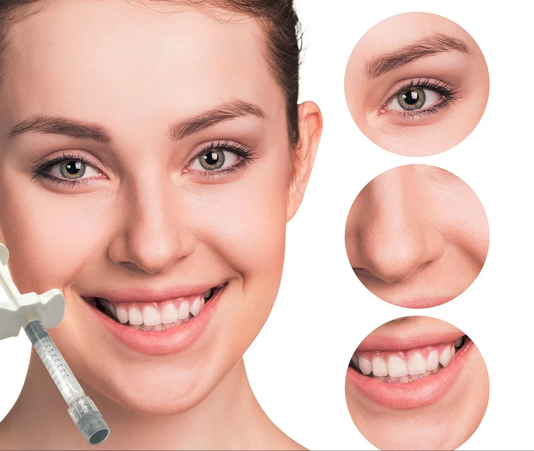 Cross Linked Hyaluronic Acid Dermal Filler for Correcting Facial Defects