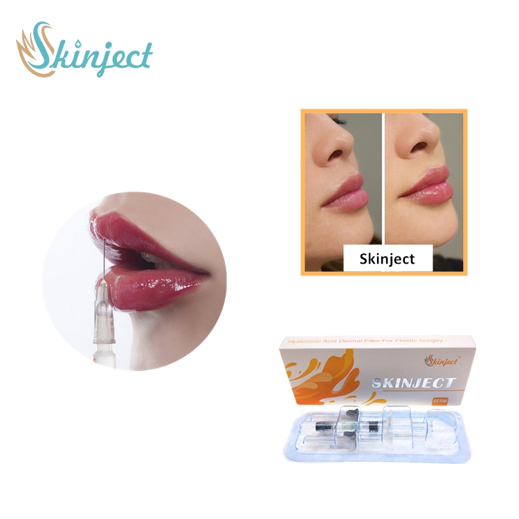 Skinject 2ml Hyaluronic Acid Injection Dermal Filler Gel for Personal Care