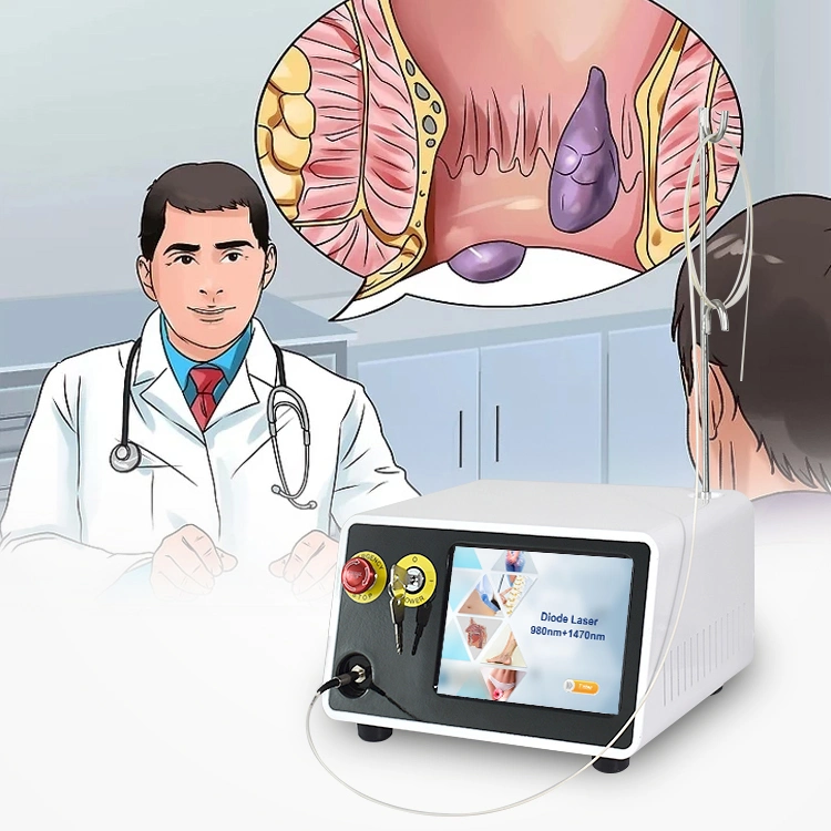 980nm 1470nm Hemorrhoids Piles Fistula Laser Ablation Proctology Laser Anorectal Hemorrhoid Laser on Proctology Anorectal Surgical Laser Hemorrhoids Treatment