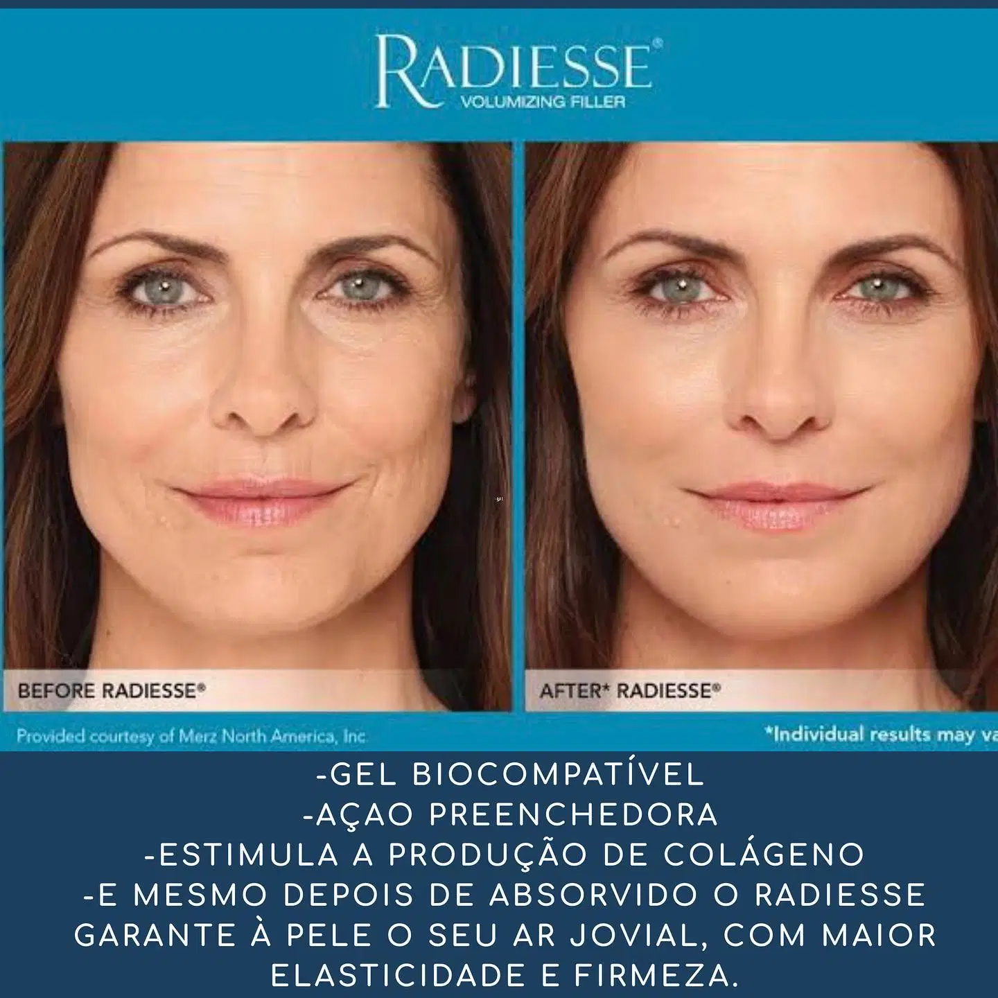 Supply Radiesse Calcium Hydroxyapatite Filler Injectable Dermal Filler Skin Booster for Anti-Aging and Wrinkle Removal