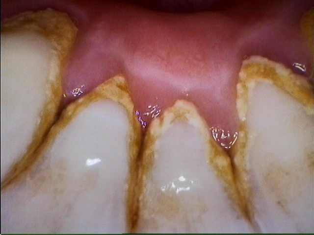 مستشعر CMOS المجاني USB Dental Indal كاميرا غير تقليدية