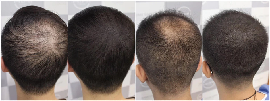 Sonwu Supply Hair Treatment Ru58841 Powder Ru-58841