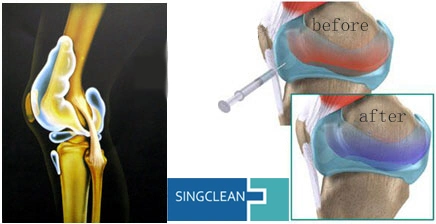 Factory Price Medical Sodium Hyaluronic Gel for Bone-Joint for Knee OA Treatment Option 1ml, 2.0ml, 2.5ml, 3.0ml, 5.0ml Manufacturer