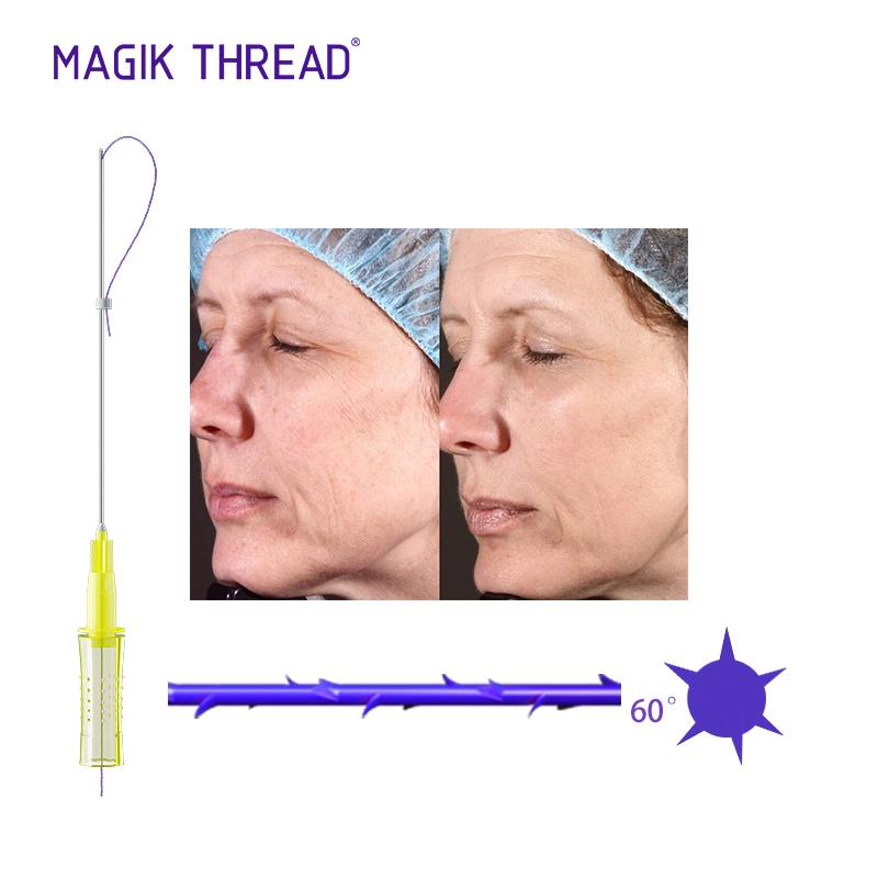 Magik Thread Disposable Medical Supplies Tear Trough Pdo Threads for Face Lifting