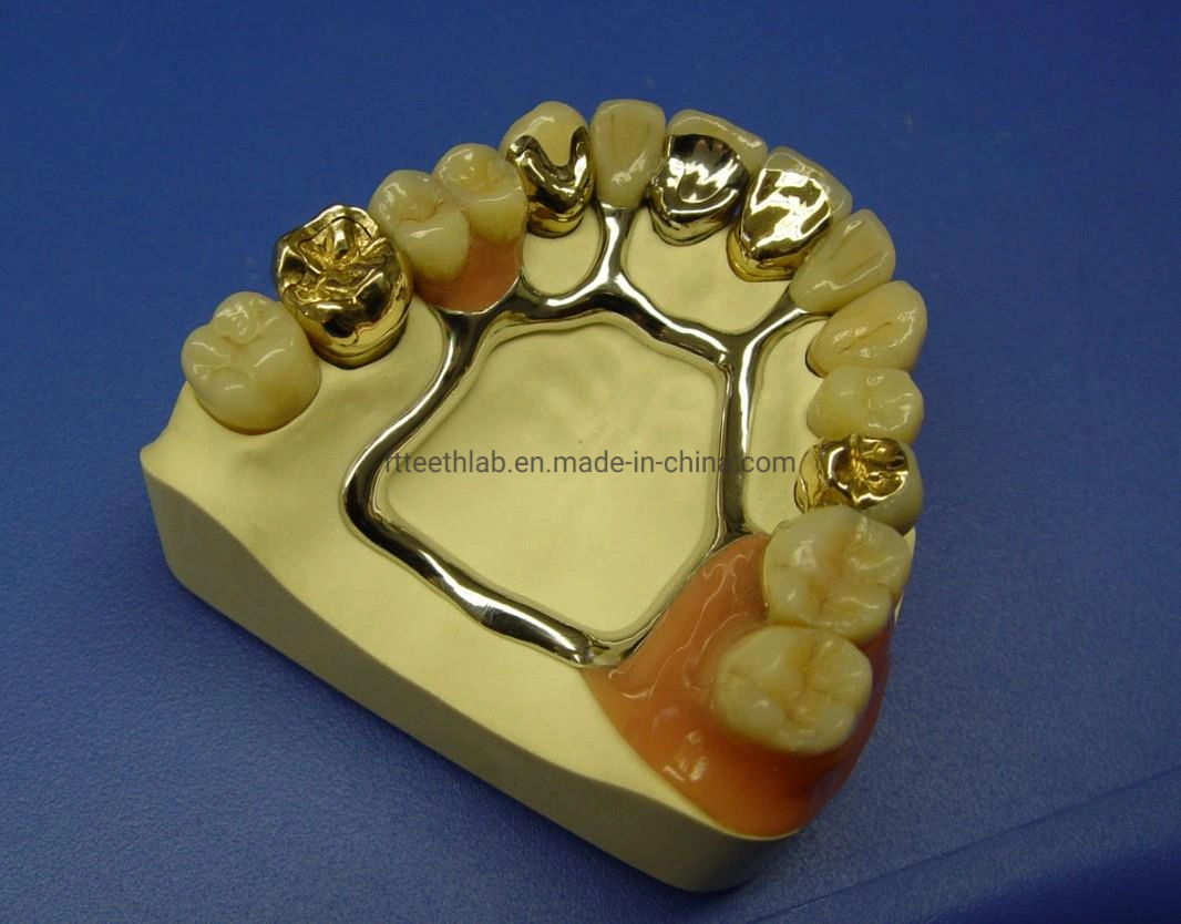 Telescópio removível dentaduras parcial fundido metal fabricado na China Laboratório de medicina dentária