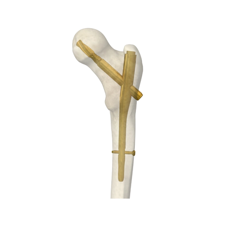 Médical Orthopédie reconstruction fémorale Nail intramédullaire Nail emboîtable Femur