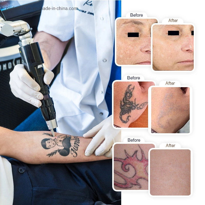 Professional Picosecond Carbon Laser Peel Tattoo Removal Q-Switched ND YAG Laser 1064nm 532nm 755nm 1320nm Pico Second Scar Spot Removal Machine