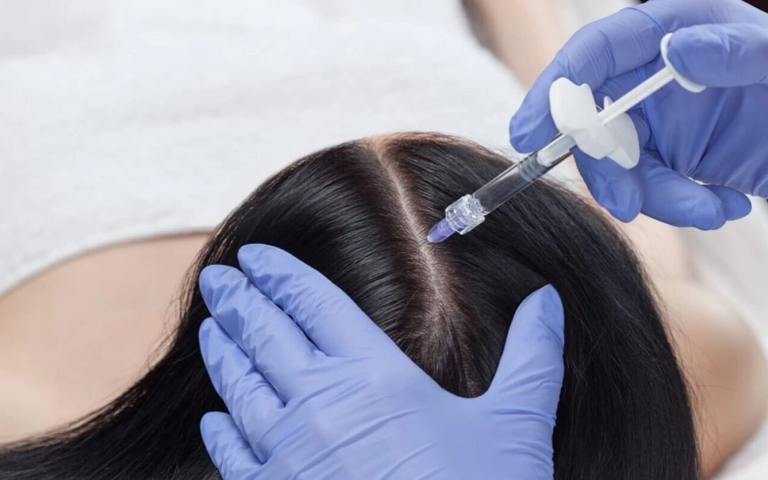 Großhandel Preis Haarausfall Lösungen Hyaluronic Dr. Cyjhairfiller Inno-TDS Haarausfall Kontrolle Mesohair 5ml Bcn Lösung Mesotherapie Ampullen Haareinspritzung