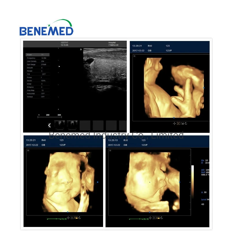 4D basado en tranvía Ecógrafo Doppler Color equipos médicos