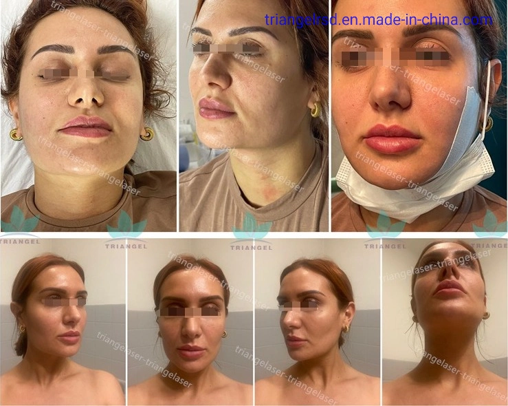 Liposuktion Laser Lipolyse Maschine Medizinische CE-Behandlung Fiberlift Plastische Chirurgie Laser