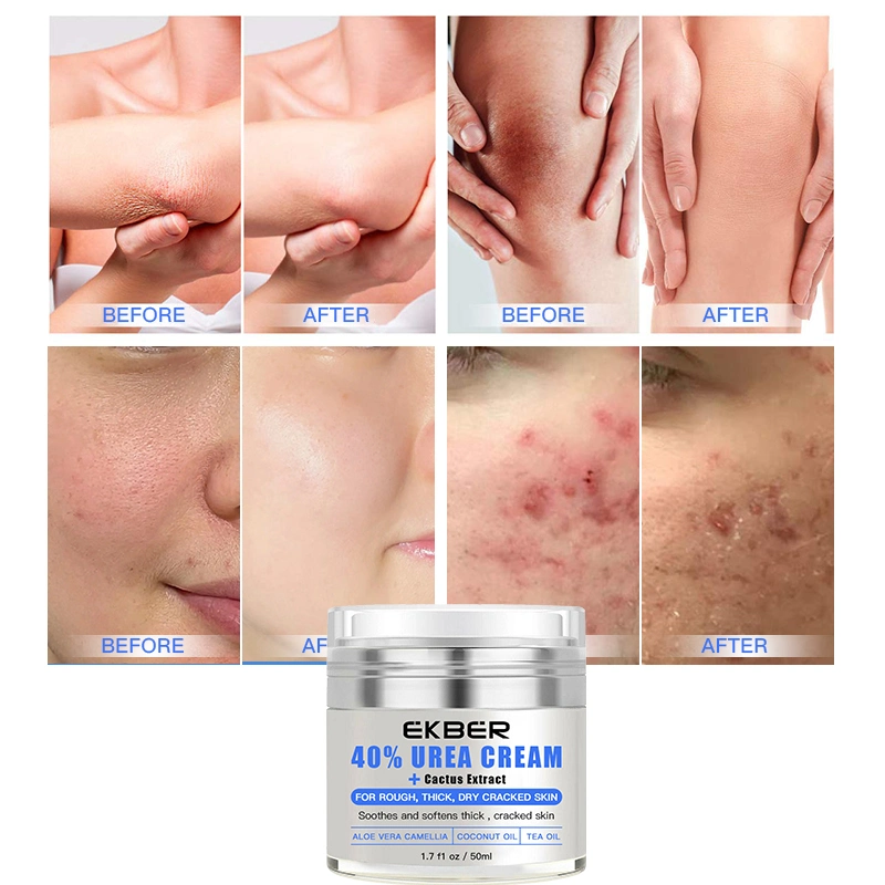 Hot Sale 40% Urea Skin Repair Cream Vitamin E Urea Moisturizing Whitening Cream