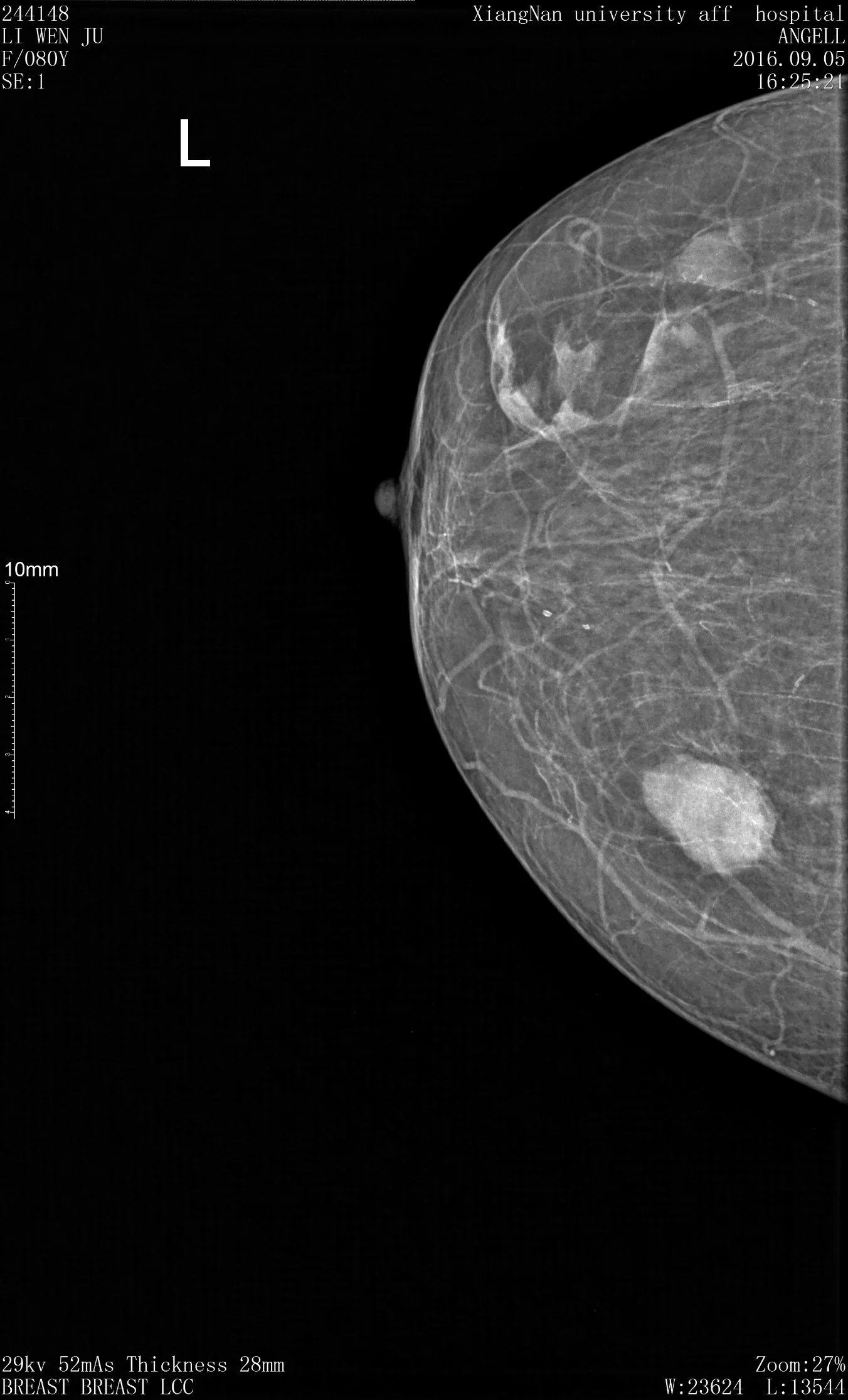 High Frequency Medical Mammography System Breast Diagnostic Digital Mammography Device