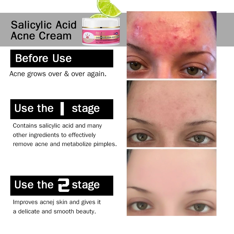 Natural Salicylic Acid Oil Control Moisturizing Acne Removal Face Cream Anti Acne Cream for Oily Skin