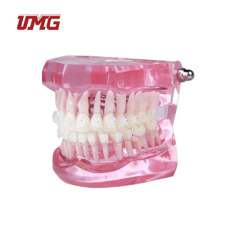 Transparent Dentition with Metal Brackets (3color) Dental Teaching Teeth Model