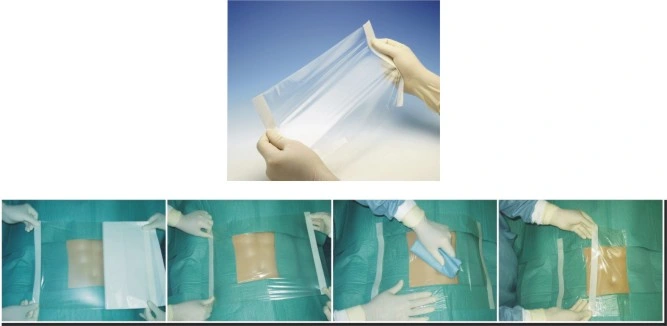 Surgical Adhesive Dressing Film/Disposable Surgical Membrane/Medical Incision Dressing Drape