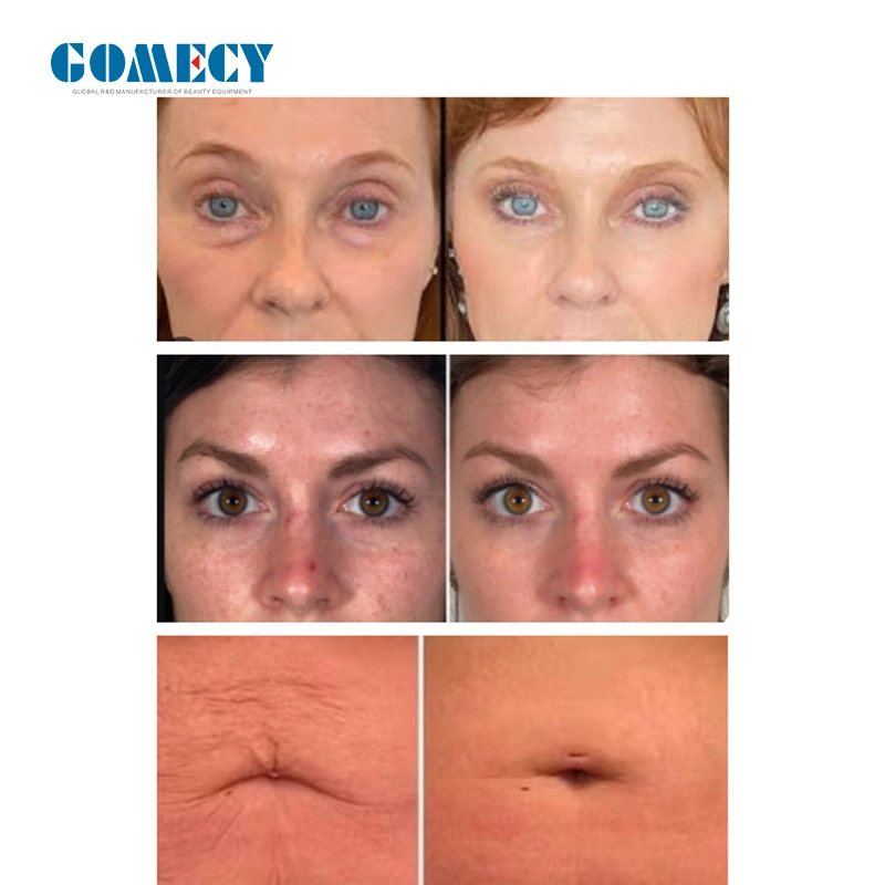 Morpheus8 RF تردد لاسلكي رفع الجلد الوجه الجبهة Wrinkle Remover ماكينة تجميل