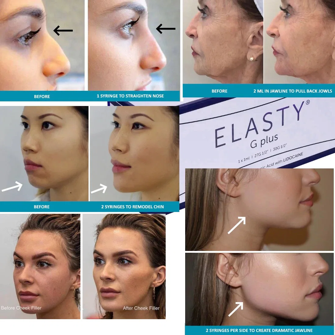 Wholesale/Supplier Long Lasting Elasty G D F Plus Dermal Filler with Lidocaine Cheek Chin Jawline Lips Nose Nasolabial Fold Hyaluronic Acid Stylage Juvederms' Gel Filler