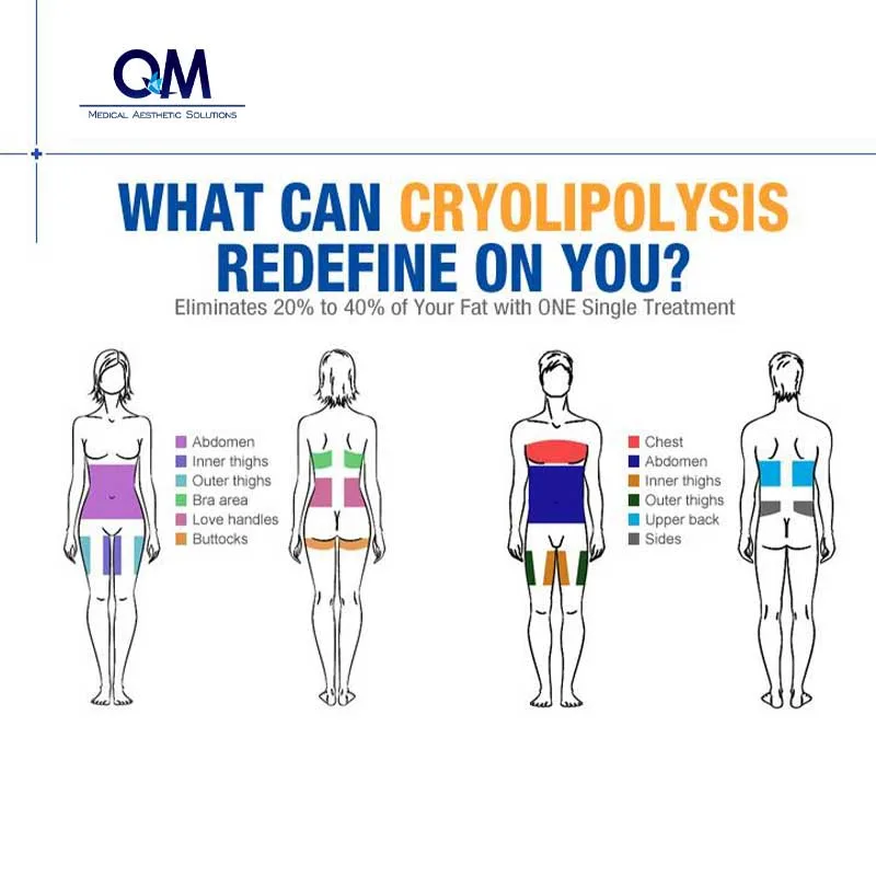 Nouvelle technologie Cryoliposolyse machine d'amincissement peau resserrage machine de cryoliposolyse