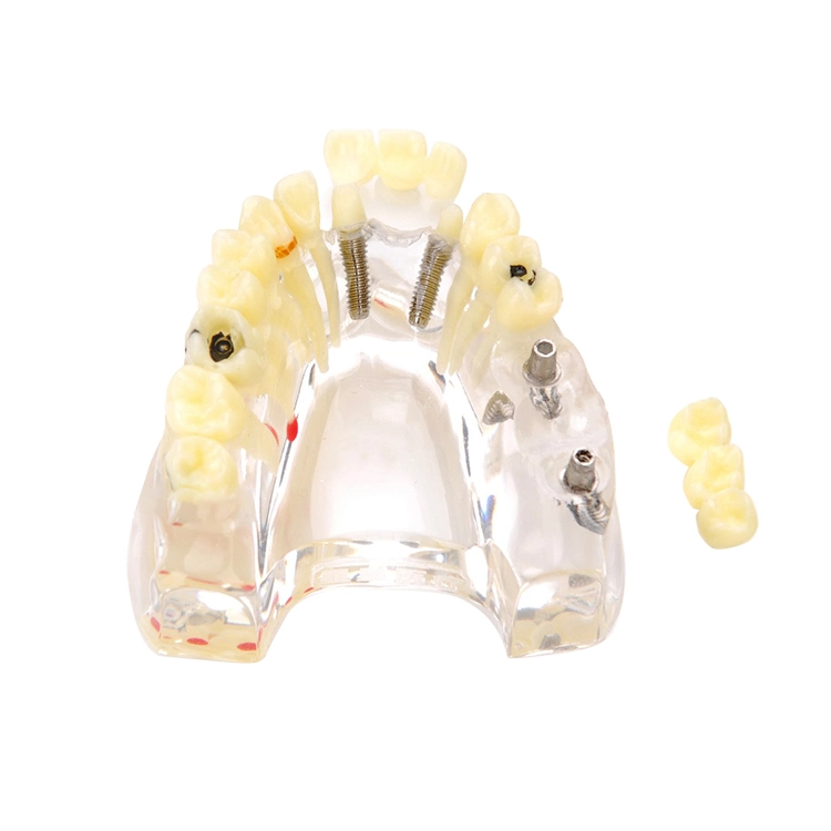 Implant Model for Showing Implant and Restoration Caries