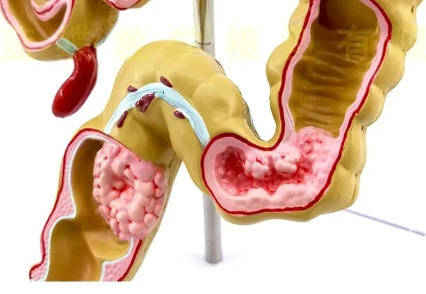 High quality/High cost performance  Medical Diseases Colon Model