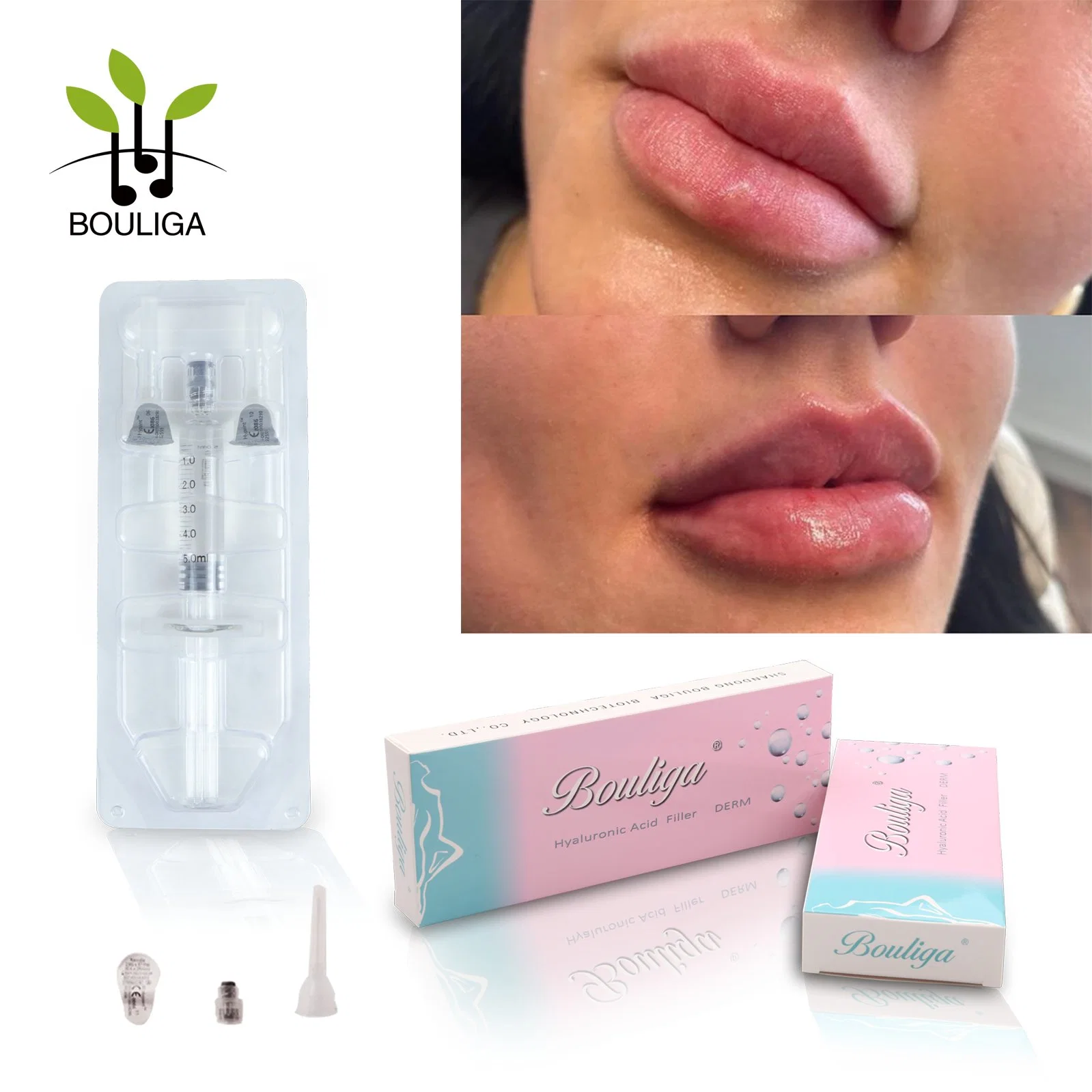 Beautiful Injection Cross-Linked Hyaluronic Acid Dermal Filler Injectable Fillers for Lip Augmentation