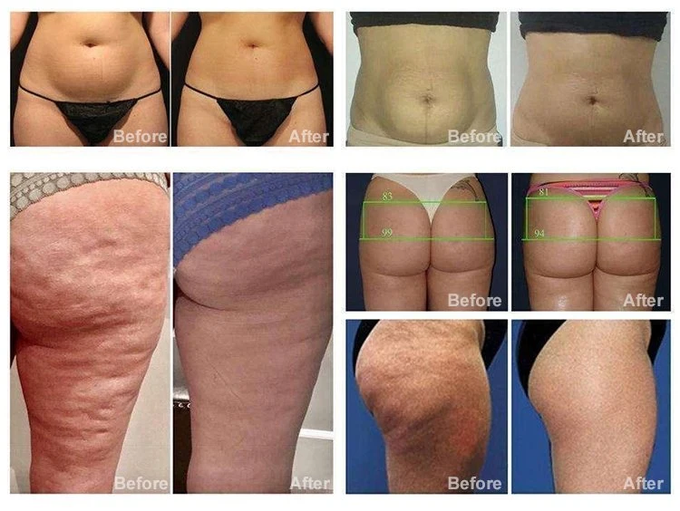 Вращающийся ролик RF Anti-Aging Ротор Negative Pressure Wrinkle Remover Cellulite Вакуумная кавитационная машина с понижающей подъемом лица