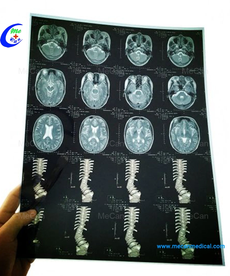 Médico de radiología de inyección de tinta seca la película de rayos X de Hospital para impresora de película