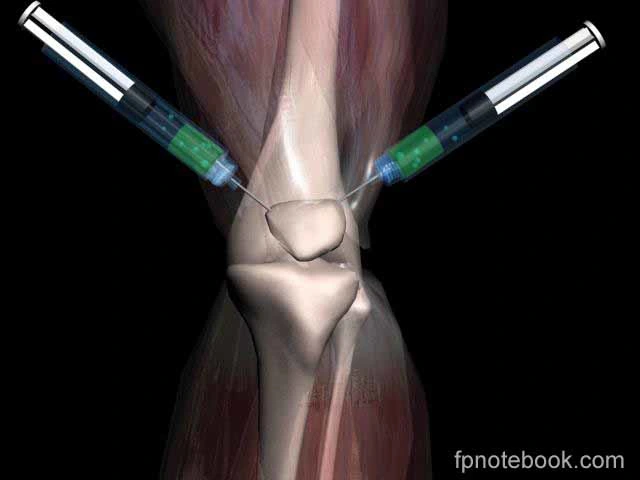 Marquage CE Singjoint l'acide hyaluronique l'arthrose pour les amateurs de la douleur d'injection