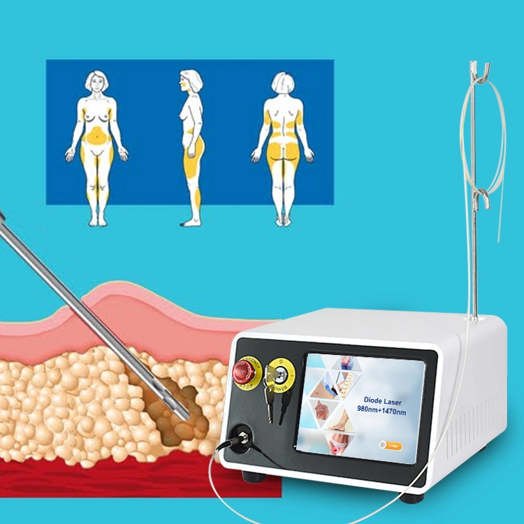 Assisted Surgical Liposuction 980nm 1470nm Fiberlift Optic Fibers Laser Lipolysis Laser Diode1470 Nm Surgery Plastic