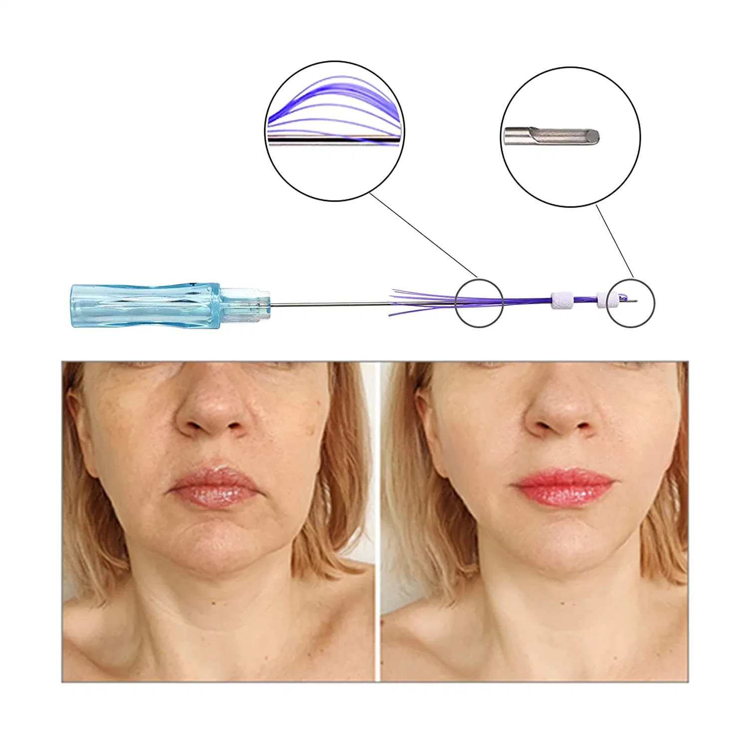 23G de alta calidad médica de la cara de 60mm de rosca Pdo absorbibles Levante Multi