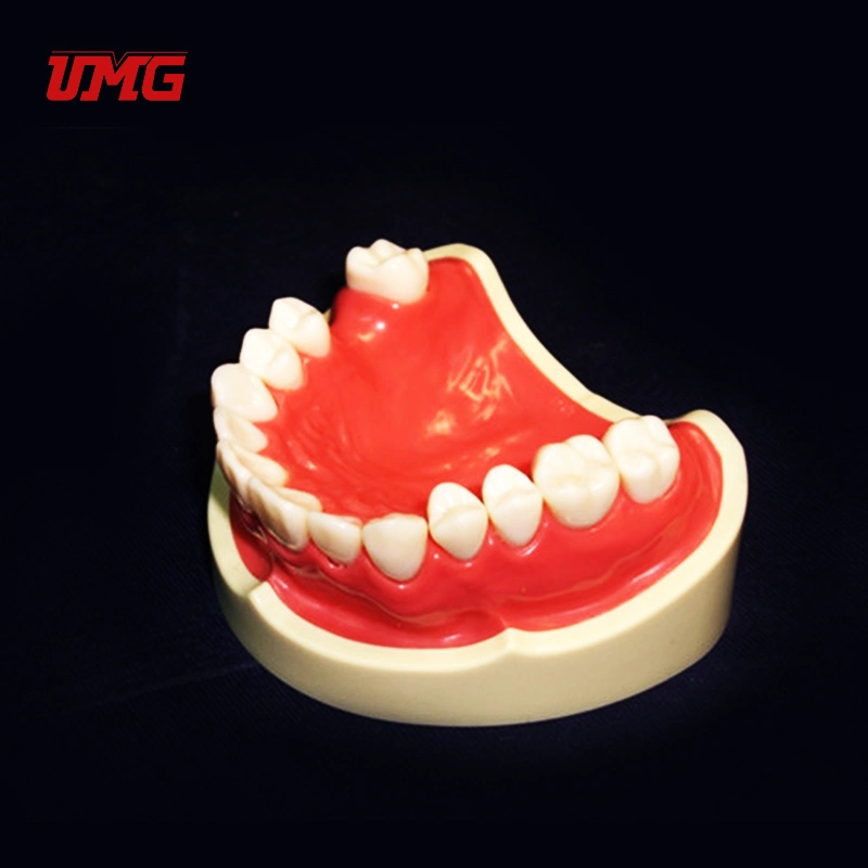 New Dental Educational Model Teeth Missing Model