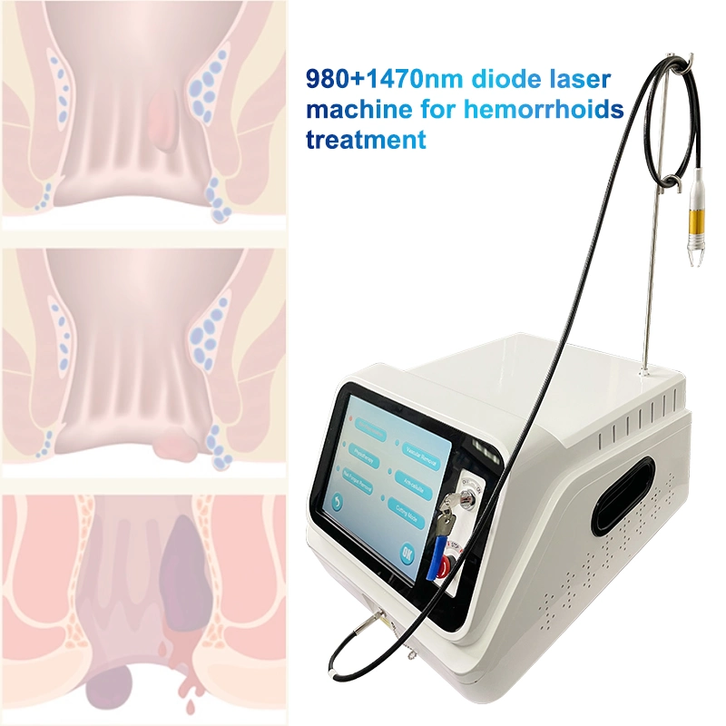 Tratamento indolor para fístulas laser de díodo inteligentes Hemorrhoids 980 Díodo laser 980 Nm 1470 Nm equipamento