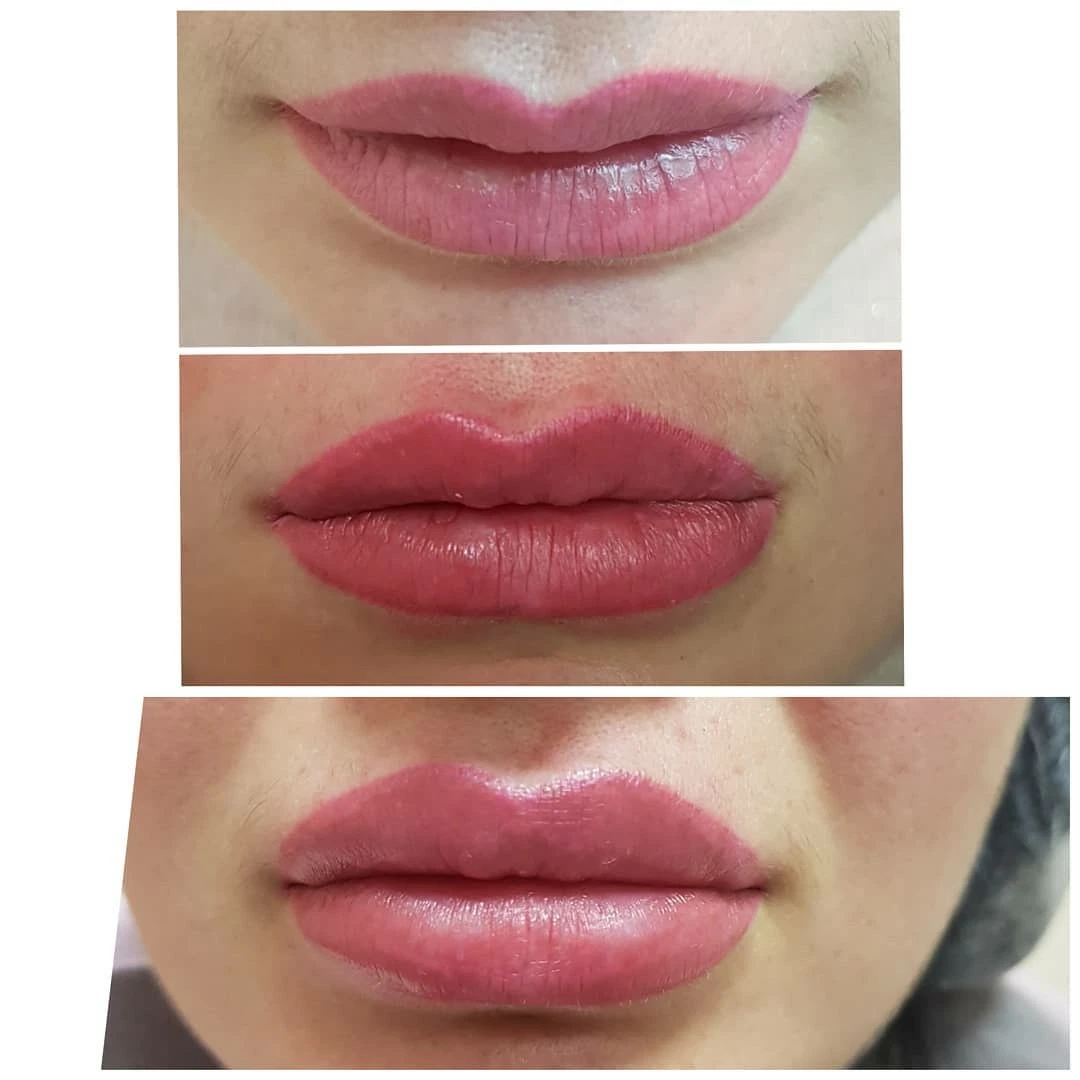 Lang anhaltende Otesaly 2ml Derm Linien Wangen-Kinn Gesicht Lip Füllmaschine