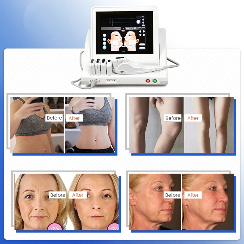 FDA Weight Loss Anti-Wrinkle Beauty Hifu Machine