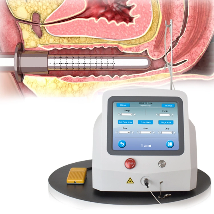 Système laser portable de chirurgie de rajeunissement et de tension vaginal 980nm 1470nm Laser à diode