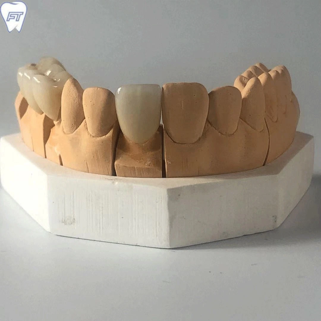 Matériel dentaire laboratoire laboratoire dentaire Implant Bruxzir personnalisé couronnes et de zirconium pont solide de la Chine Dental Lab