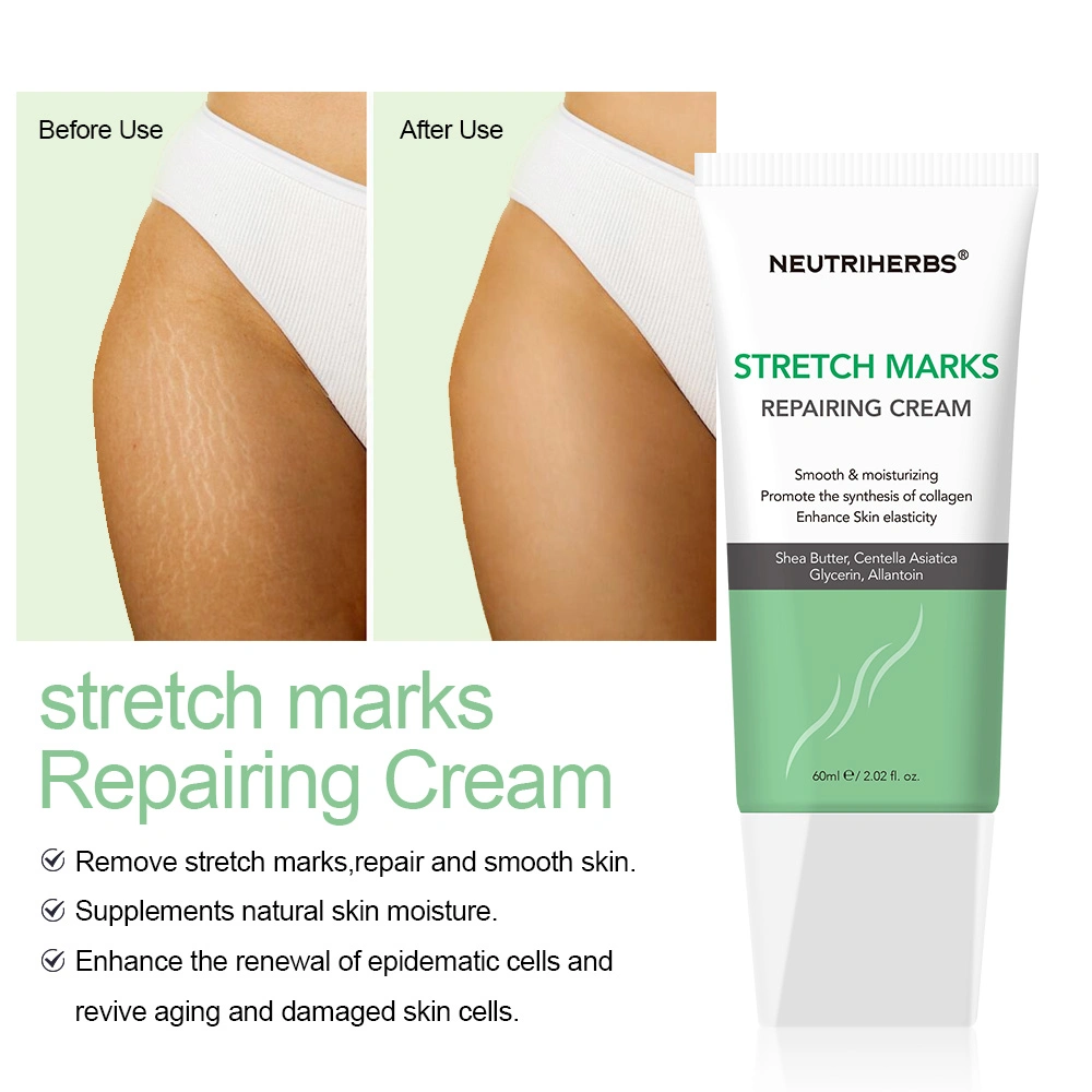 Private Label Remove Stretch Marks Repairing Smooothing Skin Stretch Mark Cream