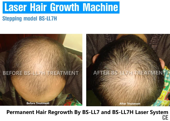 (BS-LL7H) Commercial Salon Laser Treatment Hair Regrowth Laser