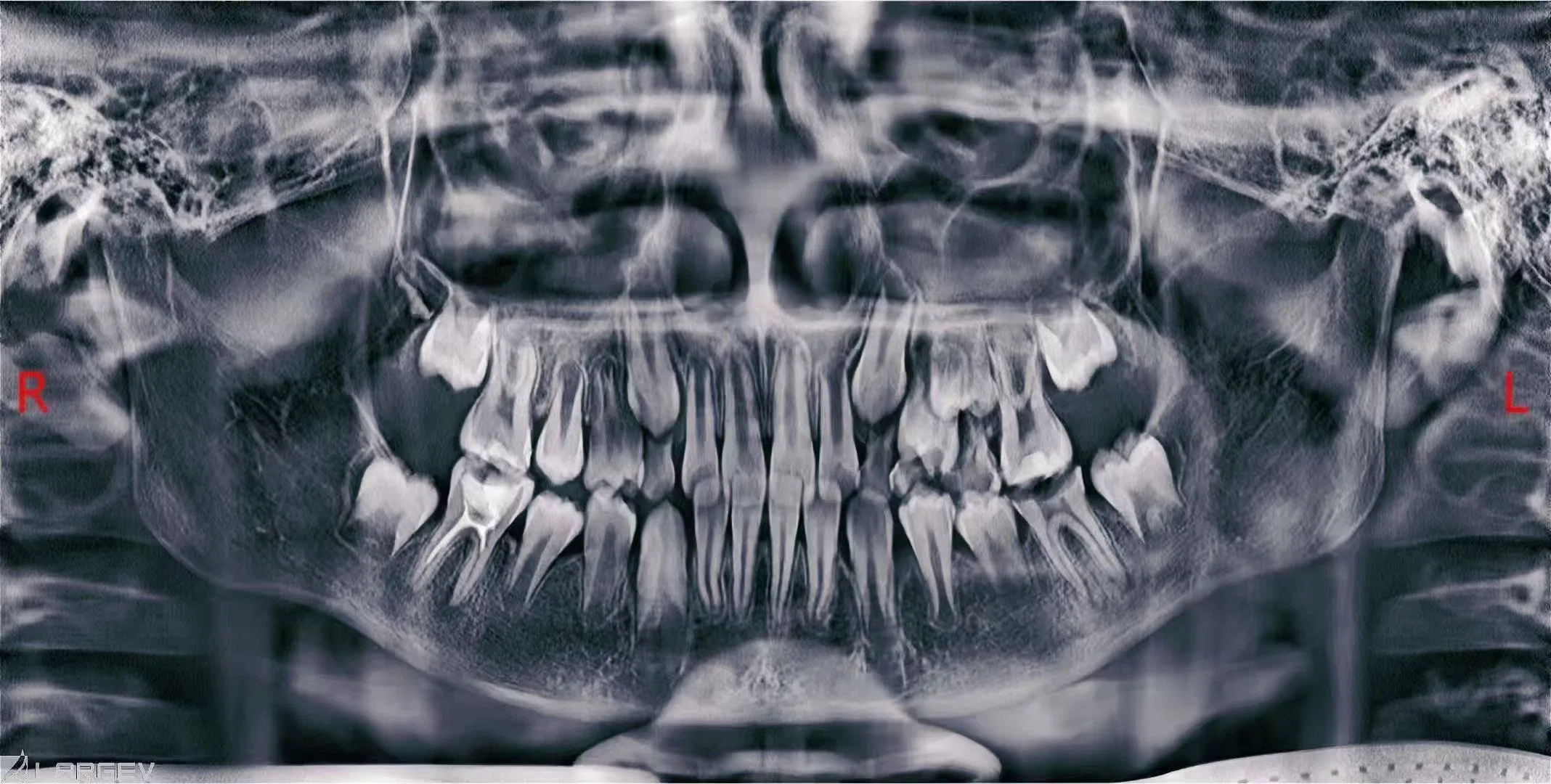 Smart 3D 2D больница клиника Dental Cbct Cephalometric цифровой панорамный рентгеновский аппарат для лечения с использованием Maxillofacial сертификат CE
