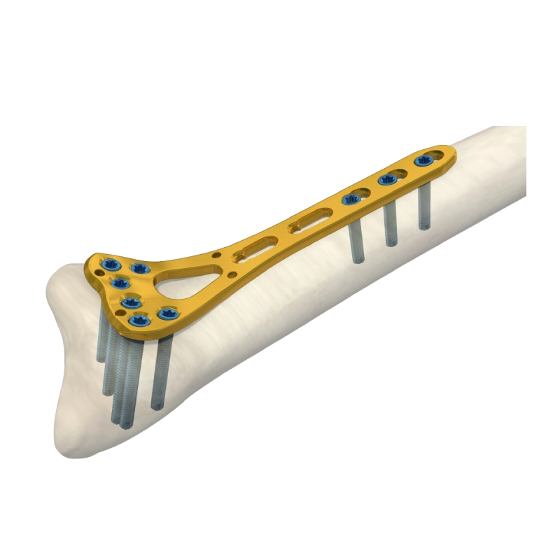 زراعة العظام التيتانيوم تقويم العظام 2.4 مم متغيرة الزاوية 2 عمود نصف قطر المسافة من لوحة LCP Bone، العرض 22 مم