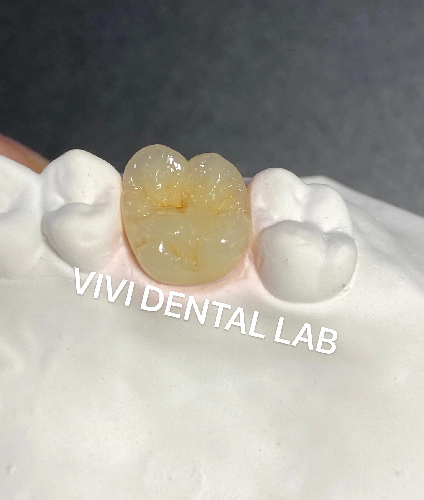 Layered Zirconia Crown - China Dental Lab Dental Crown in Good Quality, Good Fitting and Good Esthetics