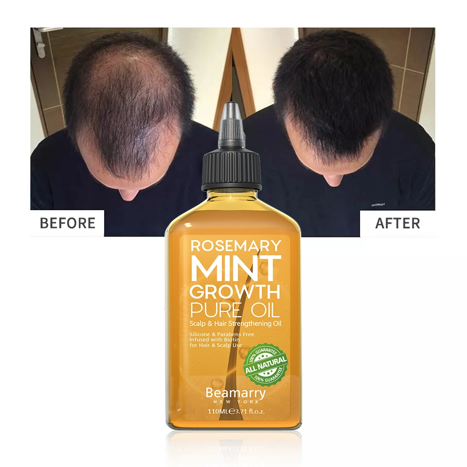 Beamarry Anti Hair Loss Prevention Treatment Hair Growth Oil Rosemary Mint Growth Pure Oil for Hair & Scalp Use